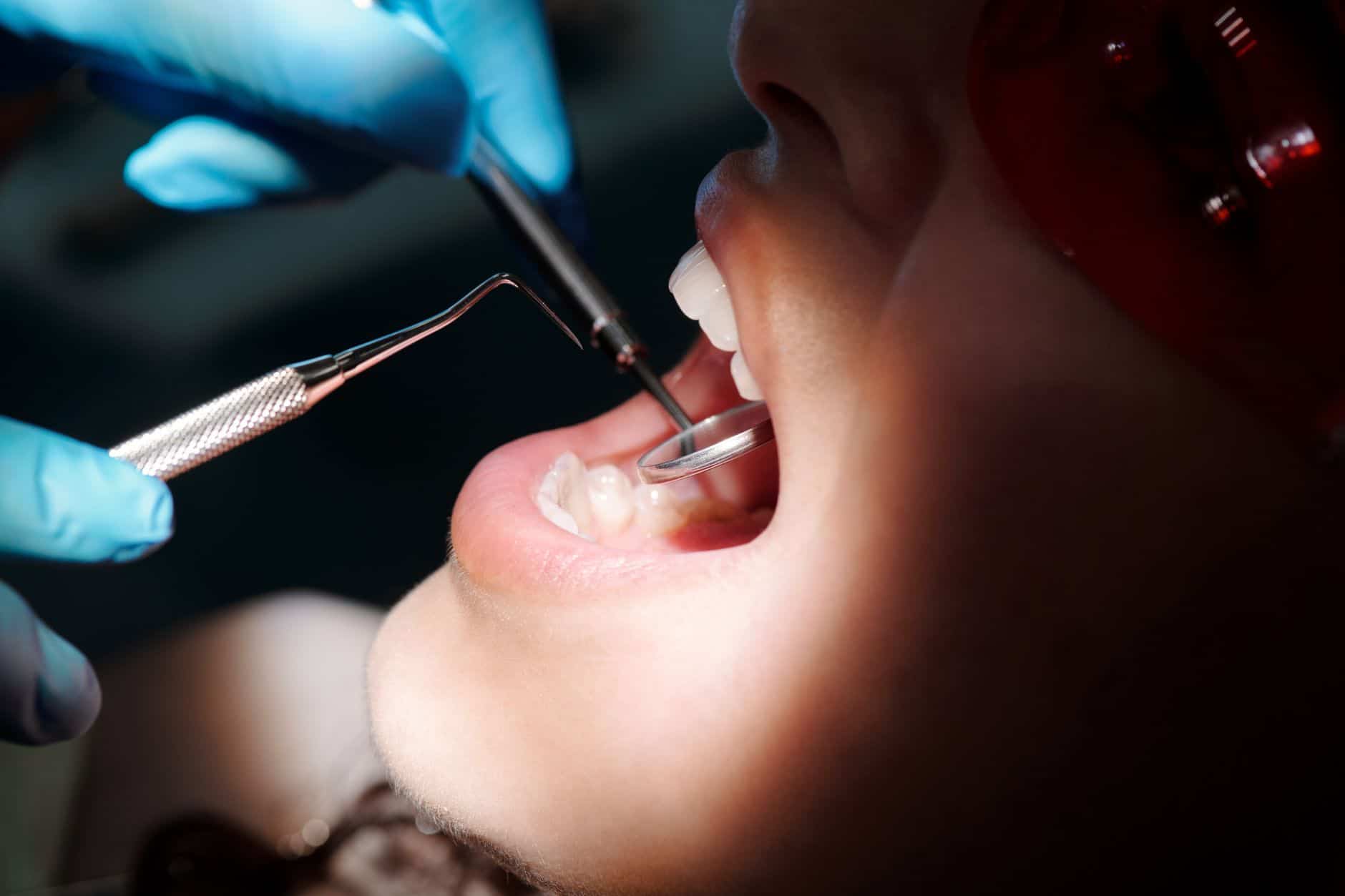 ICON Behandlung bei AUX-DENT: Karies ohne Bohren stoppen – schmerzfrei und zahnschonend