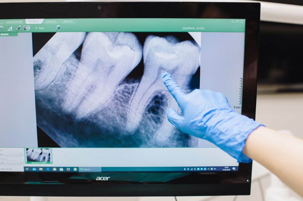 DVT (Digitales Volumentomogramm): 3D-Röntgen beim Zahnarzt