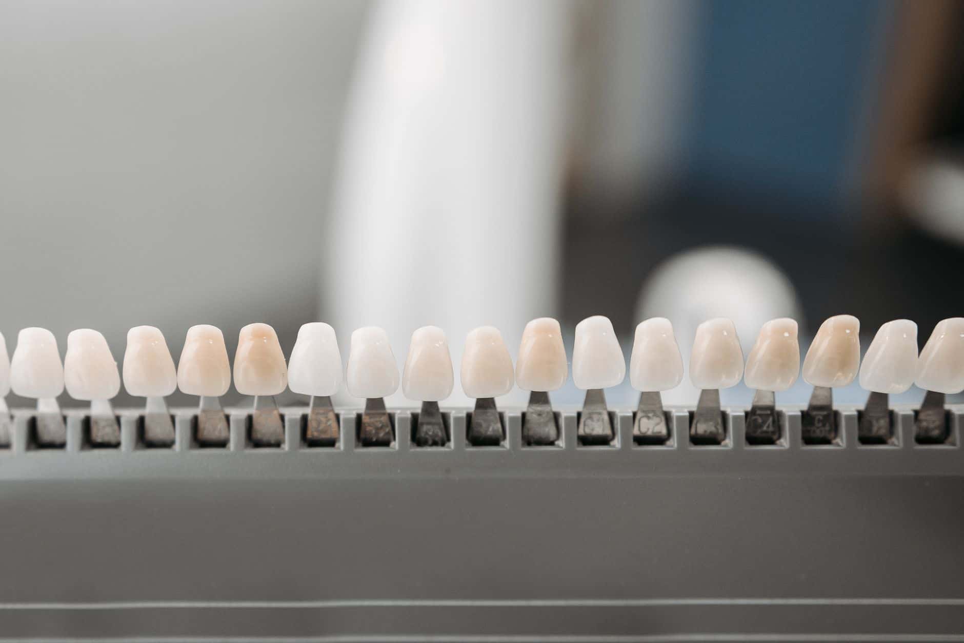 Vorher-Nachher Vergleich: Zähne vor und nach professionellem Bleaching bei AUX-DENT