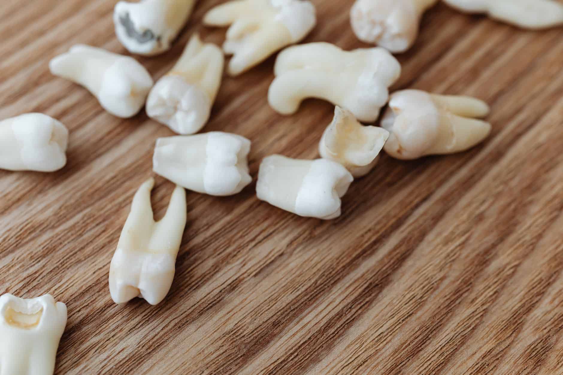 Verschiedene Stadien von Karies am Zahn: von beginnender Initialkaries bis zu fortgeschrittener Dentinkaries
