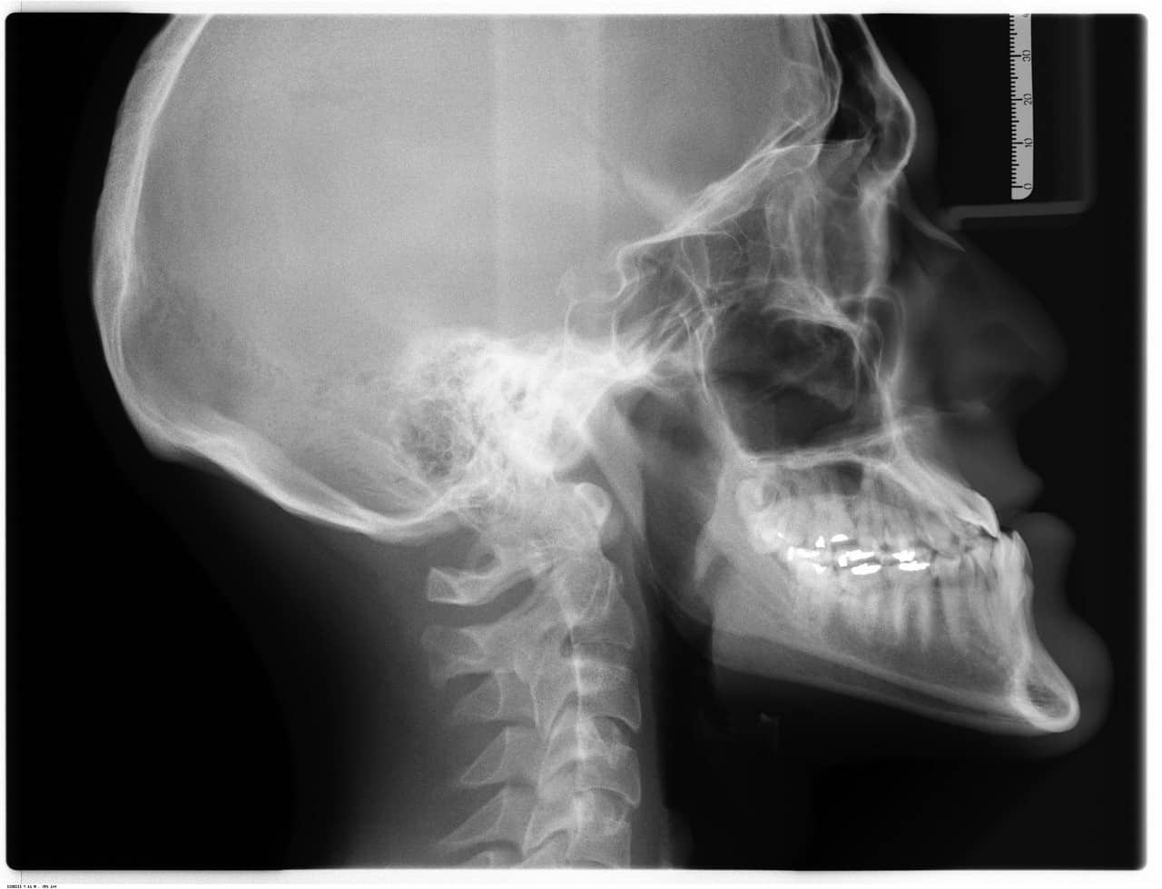 DVT 3D-Röntgen zeigt präzise Knochenstruktur für sichere Implantatplanung bei AUX-DENT